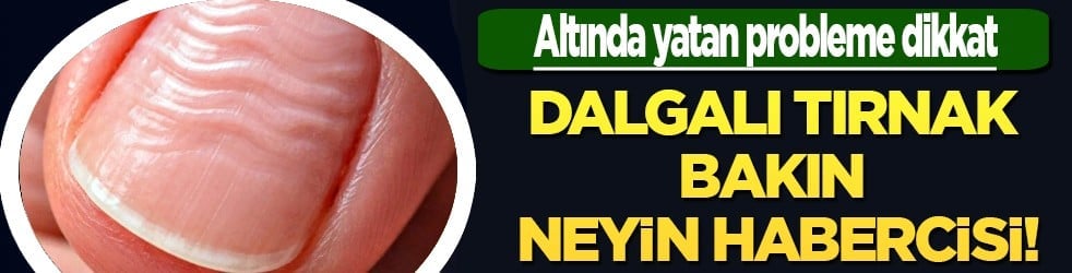 Bu uyarıya kulak verilmeli: Dalgalı tırnak bakın neyin habercisi! Vücut böyle alarm veriyor...