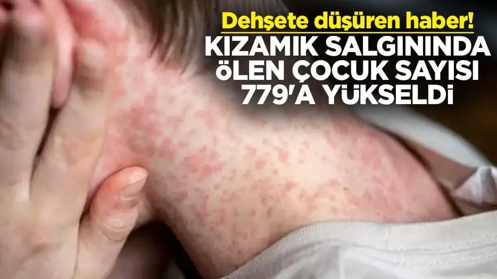 Dehşete düşüren haber! Kızamık salgınında ölen çocuk sayısı 779'a yükseldi
