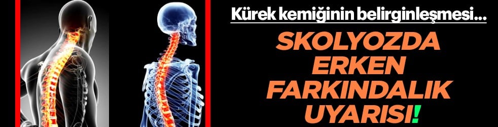 Eğer bu belirtiler varsa mutlaka doktora görünün: Skolyoz ile ilgili tüm detaylar... Tedavi yerine yeterli olmaz 