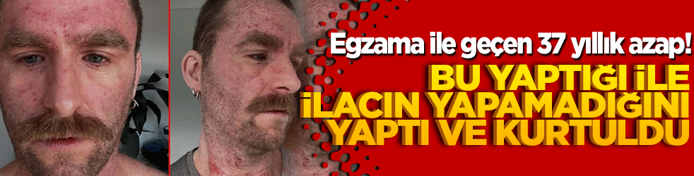 Egzama ile geçen 37 yıllık azap! Bu yaptığı ile ilacın yapamadığını yaptı kurtuldu