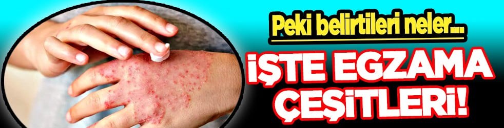 İşte o egzama çeşitleri! Peki belirtileri neler? Ciltte kuruluk, çatlaklık, kaşıntı...