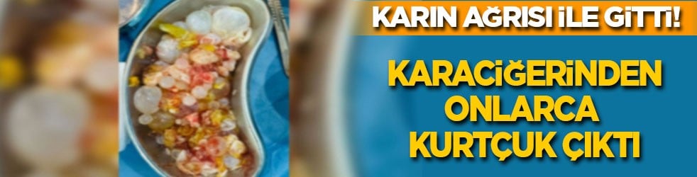 Karın ağrısı ile hastaneye gitti: Karaciğerinden onlarca kurtçuk çıkarıldı
