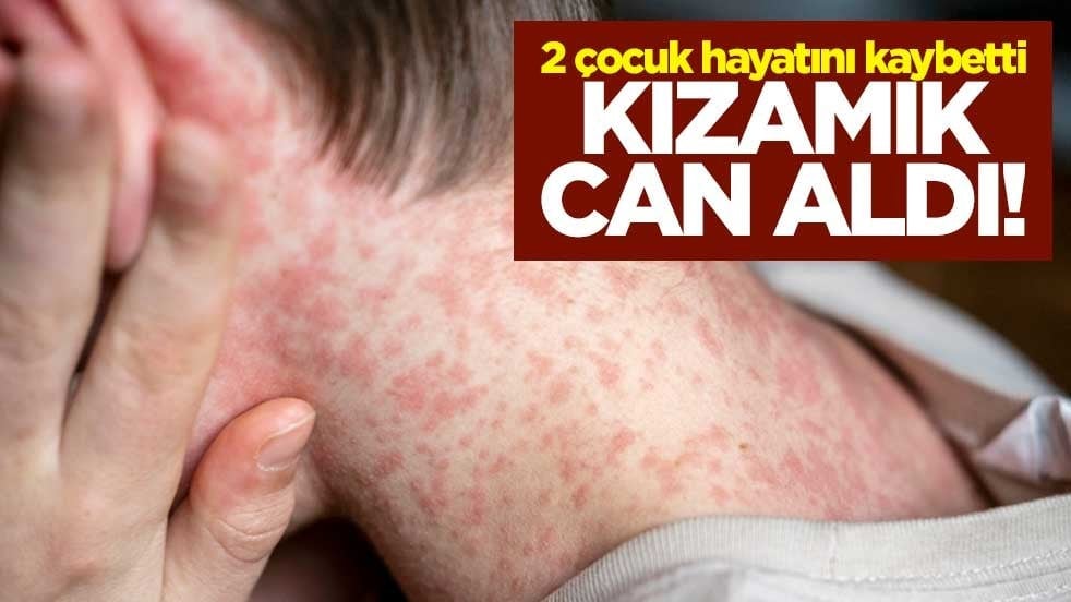 Kızamık can aldı! 2 çocuk hayatını kaybetti