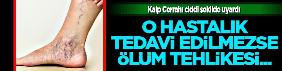 Milyonların gözü bu haberde olacak! Kalp cerrahı uyardı: Varis tedavi edilmezse