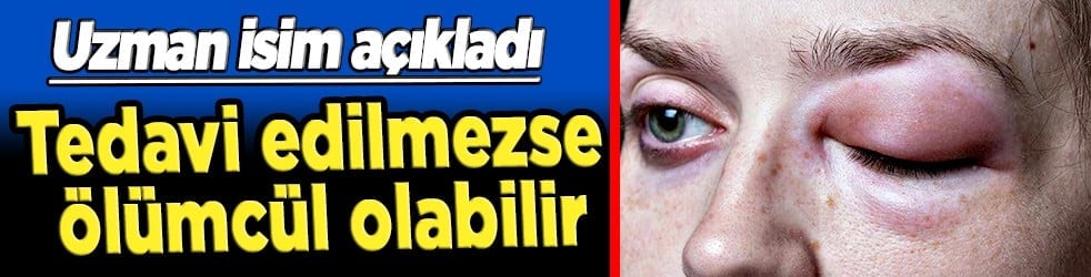 Nadir görülen herediter anjioödem hastalığı tedavi edilmezse ölümcül olabilir! Prof. Dr. duyurdu...