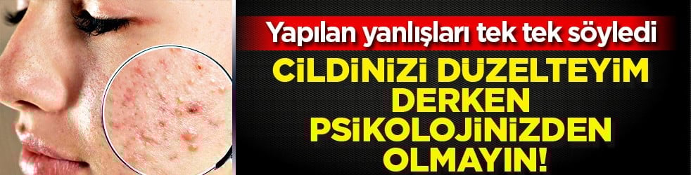 Özellikle akne tedavilerinde bunu yapmayın! Cildinizi düzelteyim derken psikolojinizden olmayın...