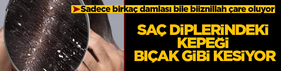 Saç diplerindeki kepeği bıçak gibi kesiyor! Sadece birkaç damlası bile biiznillah çare oluyor