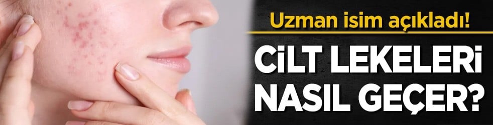 Uzman isim açıkladı: Cilt lekeleri nasıl geçer? Cilt lekelerine hangi vitaminler iyi gelir?