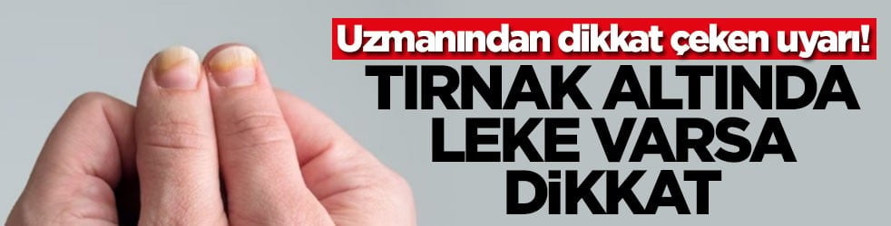 Uzmanından dikkat çeken uyarı! Tırnak altında leke varsa dikkat