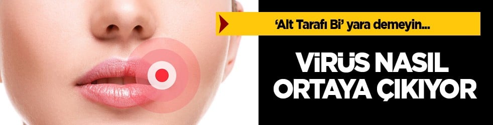 Virüs olan uçuk: Tip 1 virüsü nasıl ortaya çıkıyor? İyileşme süresi nedir? 'Alt Tarafi Bi' yara demeyin, bakın...