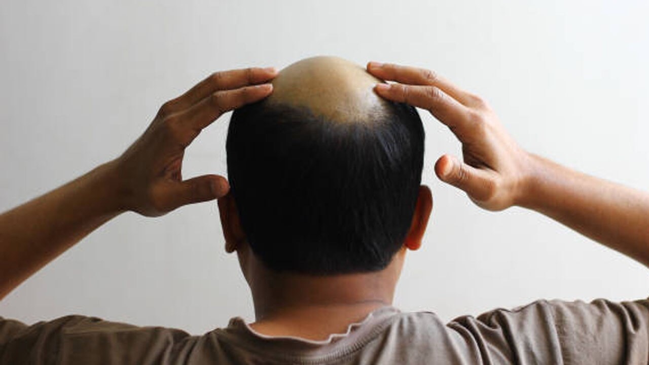 Saç dökülmesinin asıl nedeni sandığınız şey olmayabilir