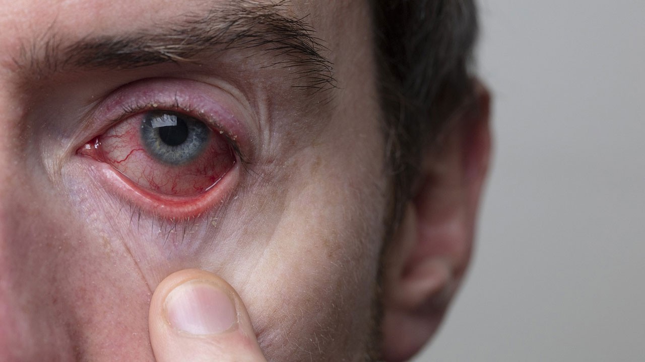 Kızarıklık sanıp geçmeyin! Tedavi edilmezse körlüğe kadar gidebilir