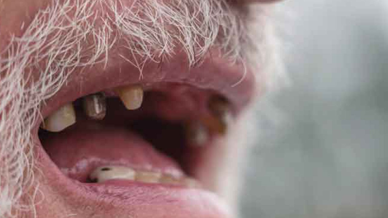 Uzman isimden dikkat çeken uyarı! Diş kaybı sizi fark etmeden yaşlandırıyor