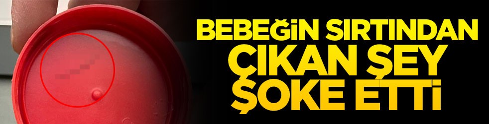 Bebeğin sırtından çıkan şey şoke etti
