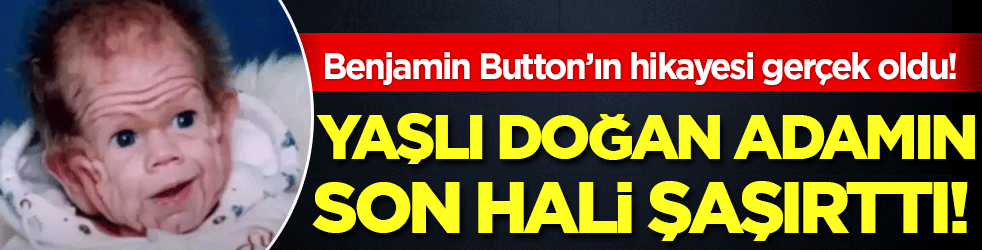 Benjamin Button filmi gerçek oldu: Yaşlı doğan adamın son hali şaşırttı!