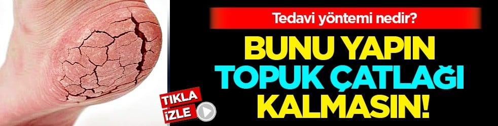 Bunu yapın topuk çatlağı kalmasın: İki malzeme ile yapın! İlaç gibi bir şey..