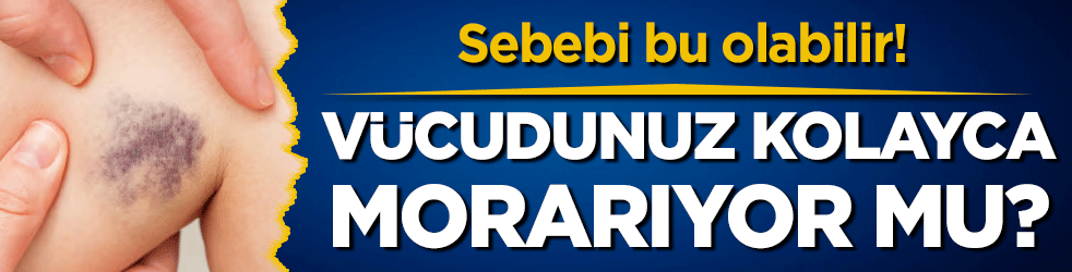 Vücudunuz kolayca morarıyor mu? Nedeni bu olabilir!