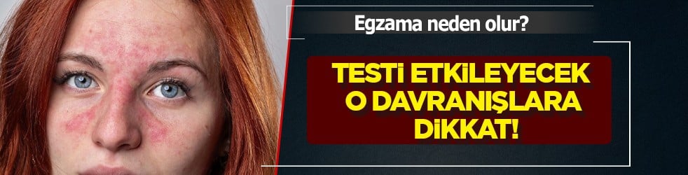 Yüzde, ayakta, elde egzama neden olur? Testi etkileyecek: Bunları biliyor musunuz? Tüm detaylara dikkat
