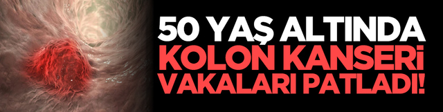 50 yaş altında kolon kanseri vakaları patladı!