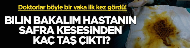 Doktorlar b&ouml;yle bir vaka ilk kez g&ouml;rd&uuml;! Bilin bakalım hastanın safra kesesinden ka&ccedil; taş &ccedil;ıktı?