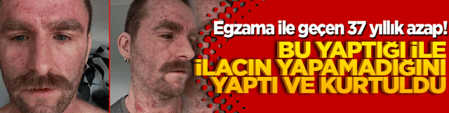 Egzama ile ge&ccedil;en 37 yıllık azap! Bu yaptığı ile ilacın yapamadığını yaptı kurtuldu