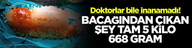 Doktorlar bile inanamadı! Bacağından &ccedil;ıkan şey tam 5 kilo 668 gram