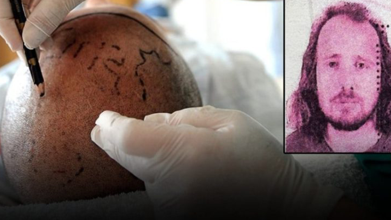 Saç ektirip dişlerini yaptırdı, öldü!