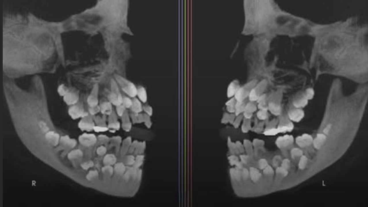 11 yaşındaki kız çocuğunda nadir diş anomalisi! Cerrahlar ve diş uzmanları harekete geçti