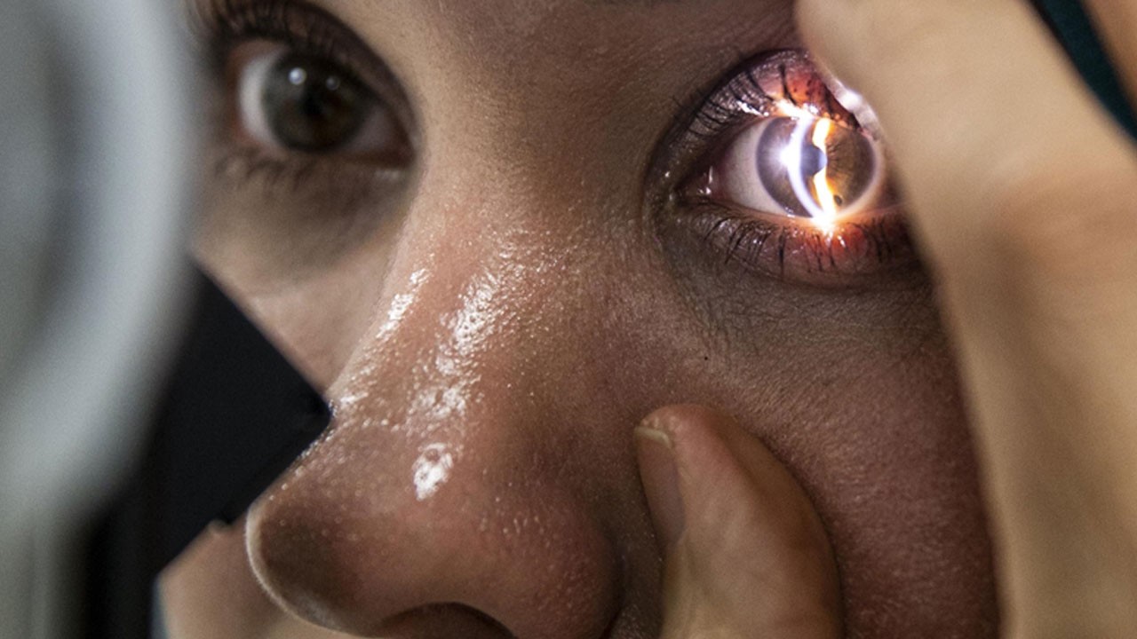 Çocuklarda fark edilmiyor! Bir göz öne diğeri yana bakıyorsa dikkat