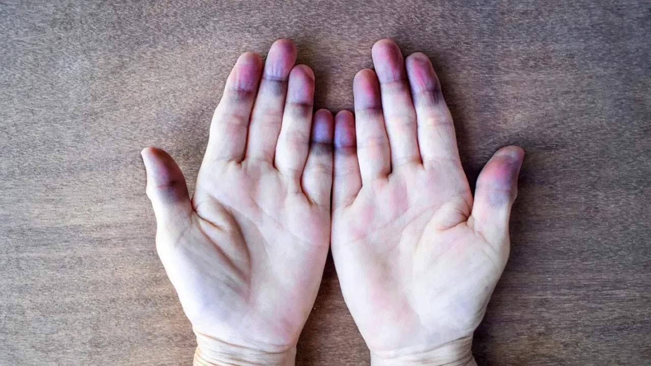 En sık genç kadınlarda görülüyor! Soğukta parmaklarınız morarıyor mu?