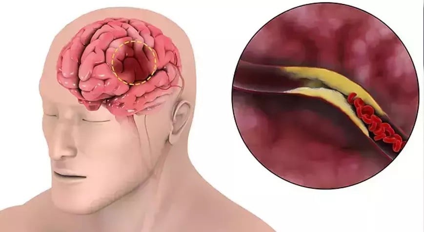 İnme sessizce geliyor! Sağlık Bakanlığı uyardı, belirtileri sakın görmezden gelmeyin
