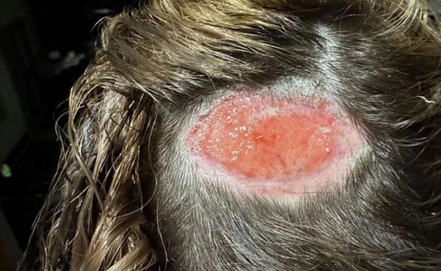 Kafada açılan delikler: Kendinize zehir enjekte etmeyin