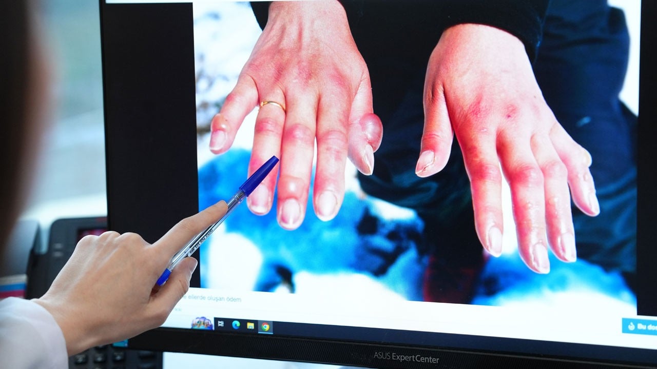 Sessiz tehlike! Geç kalınırsa uzuv kaybına kadar gidebiliyor