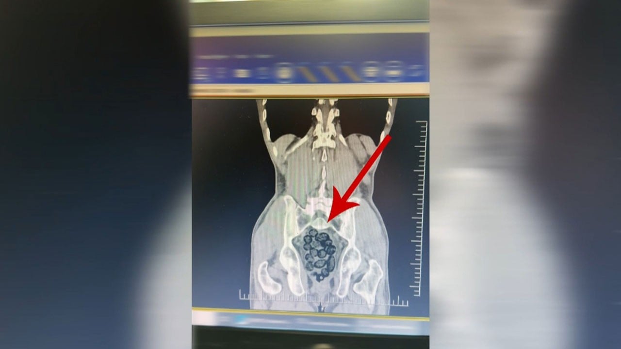 Yolcunun midesinden uyuşturucu çıktı