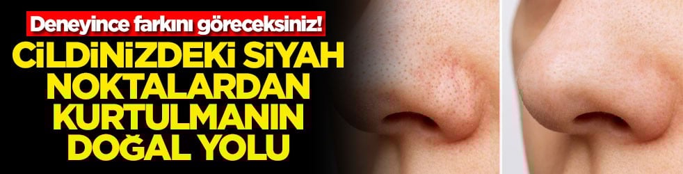 Deneyince farkını göreceksiniz! Cildinizdeki siyah noktalardan kurtulmanın doğal yolu