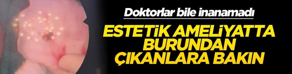 Doktorlar bile inanamadı... Estetik ameliyatta burundan çıkanlara bakın