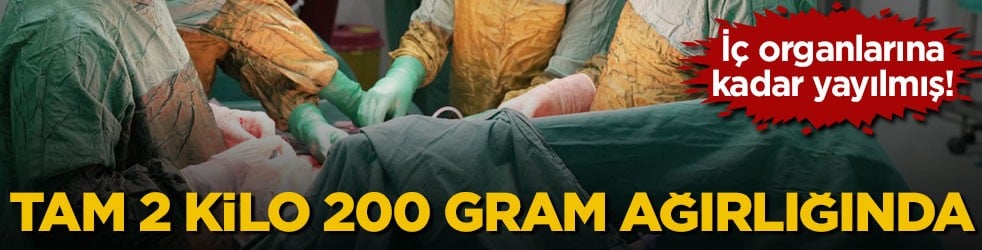 İç organlarına kadar yayılmış! Tam 2 kilo 200 gram ağırlığında