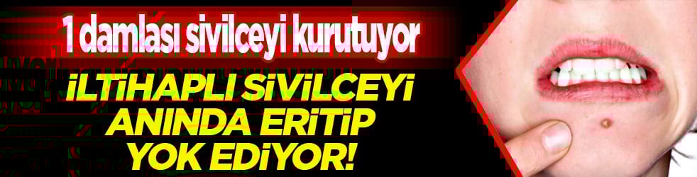 İltihaplı sivilceyi anında eritip yok ediyor! Asit gibi etkisi var, 1 damlası sivilceyi kurutuyor