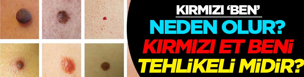Kırmızı ben neden olur? Kırmızı et beni tehlikeli midir? İşte iki profesör tek tek anlattı, verilerini açıkladı 