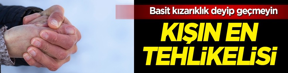Kış sert geliyor dikkat! Kışın en kötü hastalık bu: Basit kızarıklık deyip geçmeyin! 