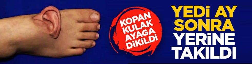 Kopan kulak ayağa dikildi: Yedi ay sonra yerine takıldı