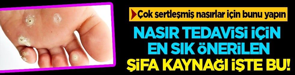 Nasır için tedavi yöntemleri: Ayaklardaki nasır problemini çözen yöntem! İlk dikkat edilmesi gerekenler! Uzak durun