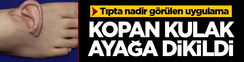Tıpta nadir görülen uygulama: Kopan kulak geçici olarak ayağa nakledildi, aylar sonra yerine dikildi