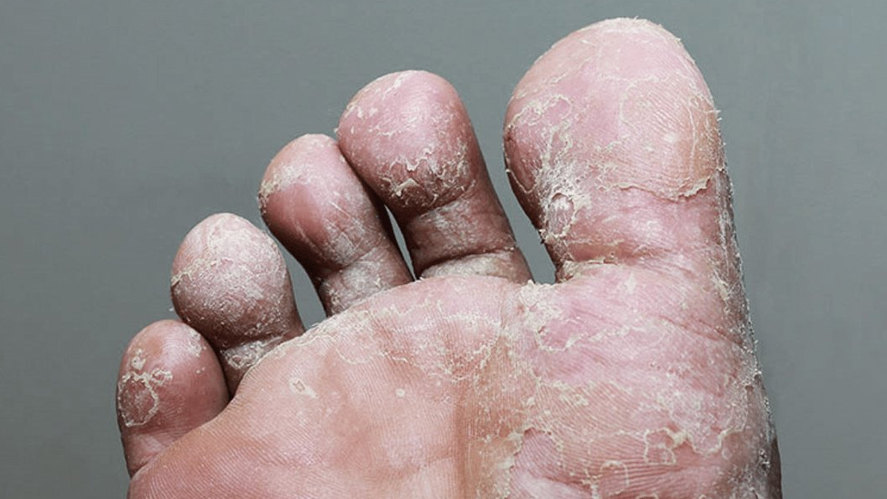 1 damlası bile mantarın kökünü kurutuyor! Suda bekletin! Herkesi şaşırtan çare...