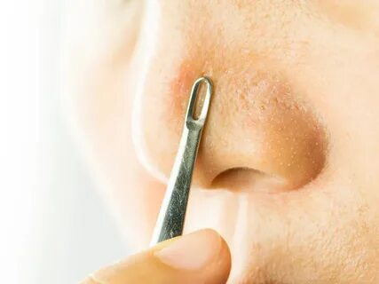 Foto - 1 kez uygulamak yetiyor! Bu metod siyah noktaları vakum gibi çekiyor