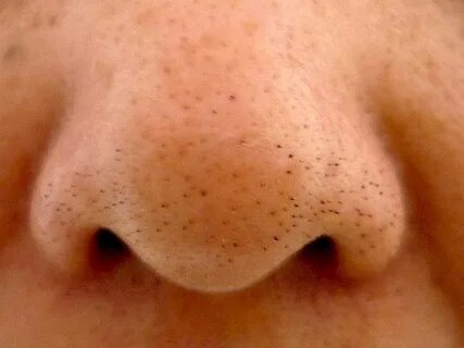 Foto - 1 kez uygulamak yetiyor! Bu metod siyah noktaları vakum gibi çekiyor