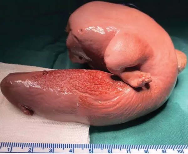 Foto - 1 yaşındaki bebek, kafası geniş olduğu için hastaneye götürüldü! Gerçek bir sene sonra ortaya çıktı! Meğerse beyninin içinde... Bilim dünyası şokta