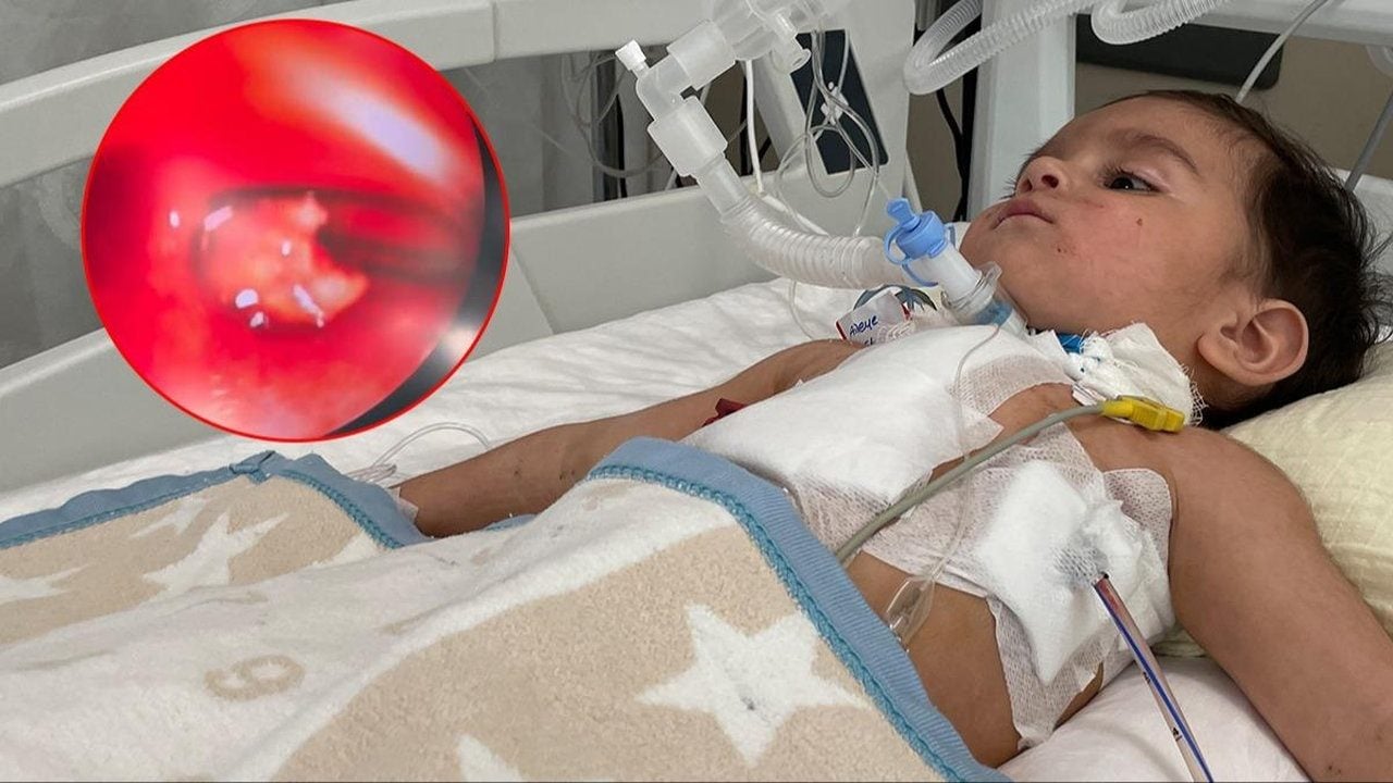 1 yaşındaki bebek ölümden döndü! Akciğerinden çıkan şey ağızları açık bıraktı