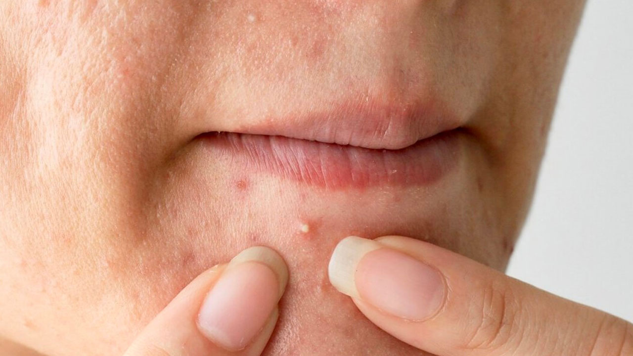 10 adımda sağlığınızı koruyun! Cilt kanseri vakaları arttı