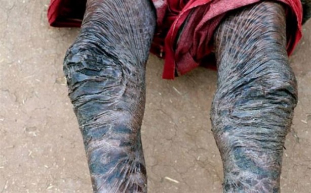 Foto - 10 günde bir yılan gibi deri değiştiriyor